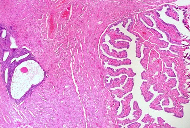 Endometriosis in Wall of Fallopian Tube, photograph by Ed Uthman. Used with permission from the creator and under CC by 2.0