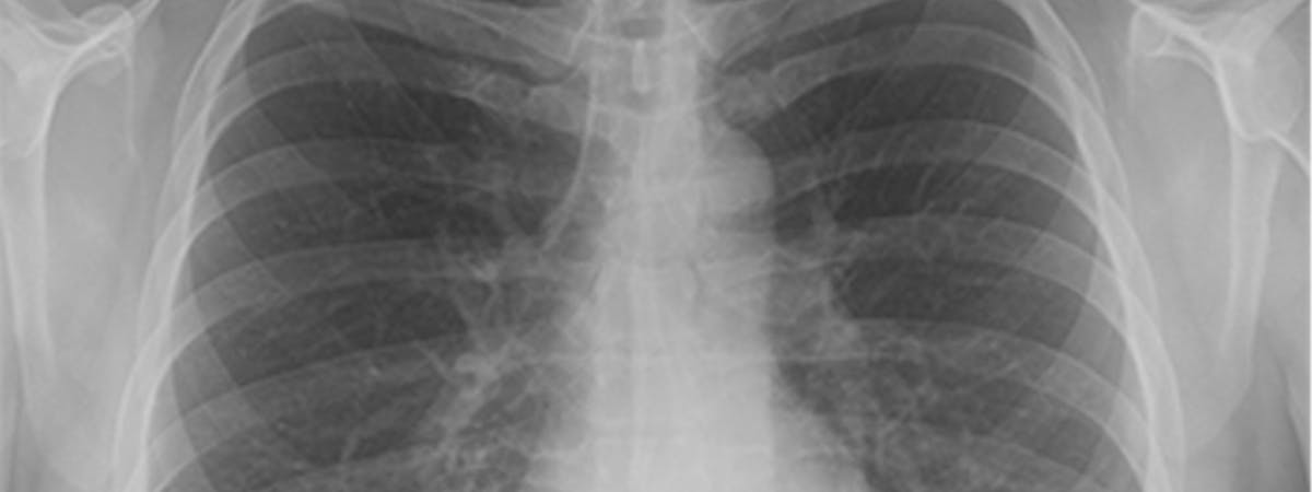 COVID-19 detection in chest x-rays